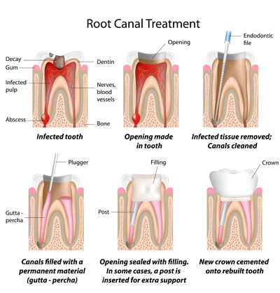 Root Canal Treatment Wallingford, CT