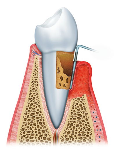 Stages of Gum Disease Wallingford, CT