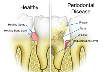 Gum Disease and Tooth and Bone Loss Wallingford, CT
