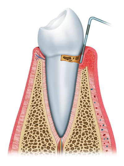 Stages of Gum Disease Wallingford, CT