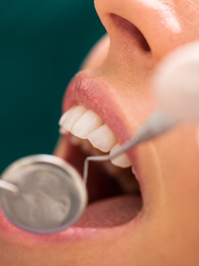 Periodontal Maintenance in Wallingford, CT