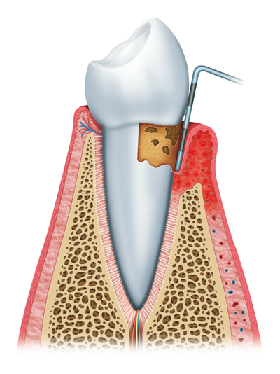 Stages of Gum Disease Wallingford, CT