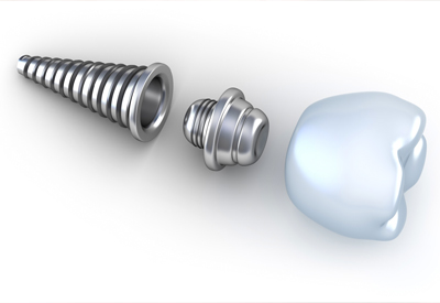 Dental Implant Surgery