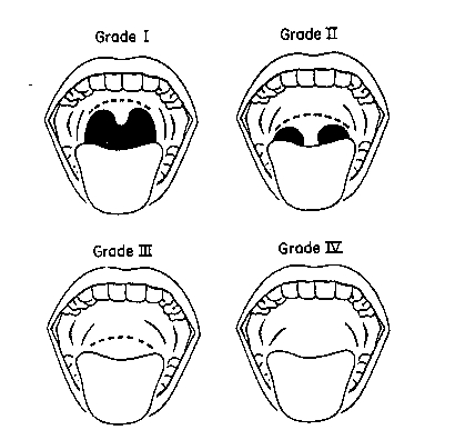 Snoring Issues in Wallingford, CT